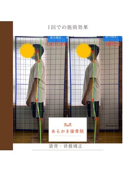 あらかき接骨院/【姿勢の変化】