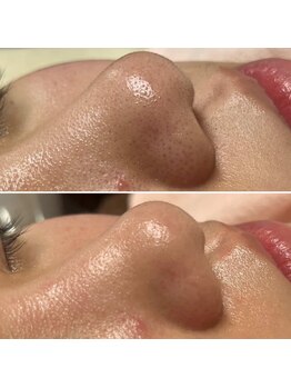 パッチ バイ サロンデヤンス(Patch by SALON DE YANSU)/毛穴洗浄ケア！！