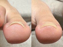 ヌル ネイル 堀江(NURU NAIL HORIE)/巻き爪矯正！正面からのショット