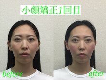 オズ六本木/小顔矯正ビフォーアフター