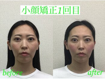 オズ六本木/小顔矯正ビフォーアフター