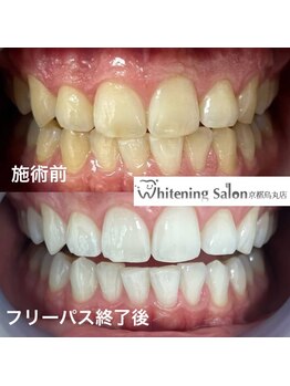 ホワイトニングサロン 京都烏丸店/ホワイトニング施術例