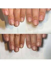 男性のお客様の割れやすい爪