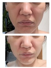 ラグーン(Lagoon)/WINBACK×小顔矯正コルギ