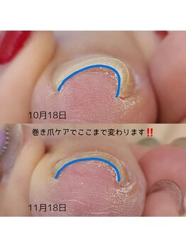 巻き爪ケア