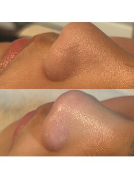 エミナル(Eminal)/◆毛穴フルコース　1回