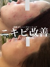 ルアナアイナ(Luana Aina)/ハーブピーリングでニキビケア