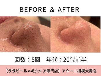 ア クーユ 相模大野店/毛穴洗浄/毛穴の黒ずみ/肌管理