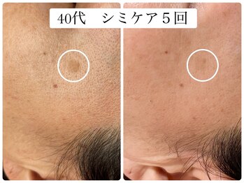 ヌー 栄(nuu)/シミケア5回　40代