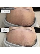 シエル(C i E L.)/フェイシャルwax脱毛