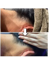 リエル(RIEL)/うなじ脱毛