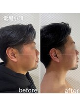 ハピネス 心斎橋アメリカ村本店(Happiness)/電場小顔リフトアップ