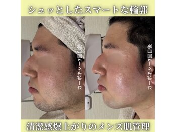 ハニエル(Haniel)/カーボキシー症例