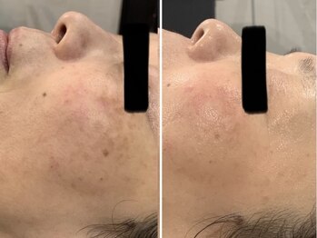 ケイ(Kei)の写真/肌の根本からケア!ハリやくすみを改善し透明感のある艶やかなお顔に♪本気で肌質改善をしたい方も◎