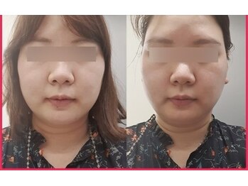 ケイビューティーサロン(K BeautySalon)/コルギの効果