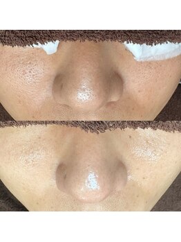 エクラ バイ シャンリィ(eclat by shanLy)/ザラつき解消