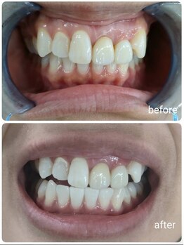 エクシアホワイトニング 沖縄宮里店/お客様ビフォア