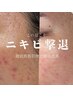 【ニキビ撲滅】徹底肌質管理で脱ニキビ肌¥15000→¥10000