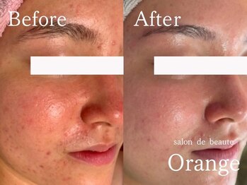 サロンドボーテ オランジュ(salon de beaute Orange)/長年のお悩みニキビケア/約1年半