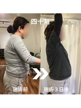 からだサロン サニー 堺東(SUNNY)/肩の痛み