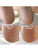 ニコプラス(NICO+)/足裏の乾燥や角質が気になる方へ