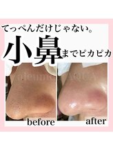 アルムダアクア 天王寺店(Aleumda AQUA)/毛穴エクストラクションプロ大阪