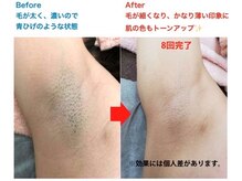 効果実感に自信あり◎夏までにムダ毛とサヨナラ♪