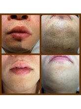 リアンジュ/ヒゲ脱毛の経過