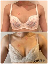 リール 新宿店(RIRE)/20代前半　バストアップ症例