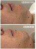 【メンズ脱毛】青髭が気になる方へ痛みの少ない脱毛￥7000→￥6000