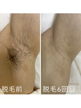 クイーン 熱海店(Queen)/脇の毛が気になっていつも袖付き