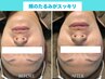【シワ・たるみ改善】エイジングケアコース★90分15,800円