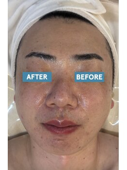 ミピマム 恵比寿店(Mipimam)/30代男性 半顔変化写真