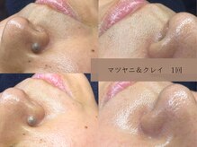 ヴィーヴォ(Vivo)/マツヤニ＆クレイ