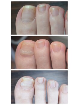 アンティ(Aunty)/巻き爪補正