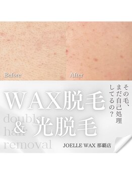 ジョエルワックス 沖縄那覇店(JOELLE WAX)/那覇市で人気WAX＋SHRダブル脱毛
