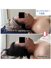 ノリスズ(NORI SUZU)/小顔/二重アゴ/フェイスライン