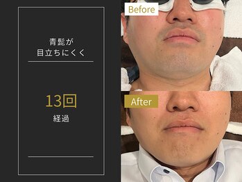 ステイゴールド 新百合ヶ丘(STAY GOLD)/おヒゲ脱毛の経過☆