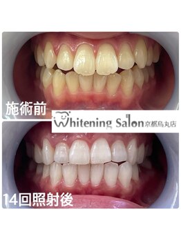 ホワイトニングサロン 京都烏丸店/ホワイトニング施術例