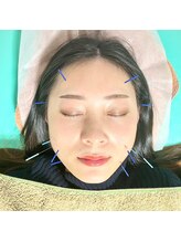 ゆしんアネックス/美容鍼の施術風景★