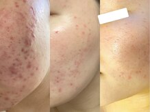 サロンドリー(salon de Re)/肌質改善はお任せください