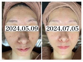 ホワイトアクア つくば店(WHITE AQUA)/ララピール/ つくば/茨城/艶肌