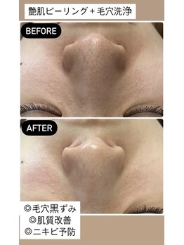 リジュベネ(rejuvena)/【取れなかった鼻の黒ずみが！】