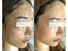 ストーリー 沼津店(STORY)/ハーブピーリング専門店STORY