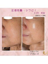 プライベートサロン 美月/圧倒的艶肌！シワケアにも最適！