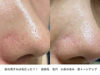 ピュアノア 垂水店/ 産毛脱毛 顔脱毛　神戸垂水明石