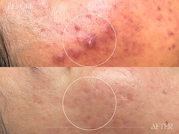 シェステ ゴジュウヨン(shesthe54)/症例写真|ニキビケア