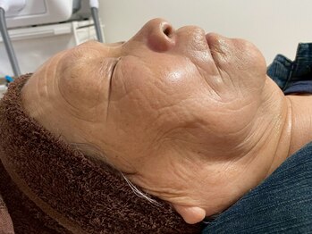 サロン アンネ(Anne)の写真/【肌の土台を整えるエイジングケア】ほうれい線やたるみにアプローチするプロの施術で若々しい見た目に♪