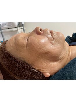 ホウレイ線・たるみ改善！予防ケア