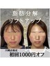 【顔脂肪・ボリューム感・たるみがになる方に】美容鍼+脂肪分解たるみリフト